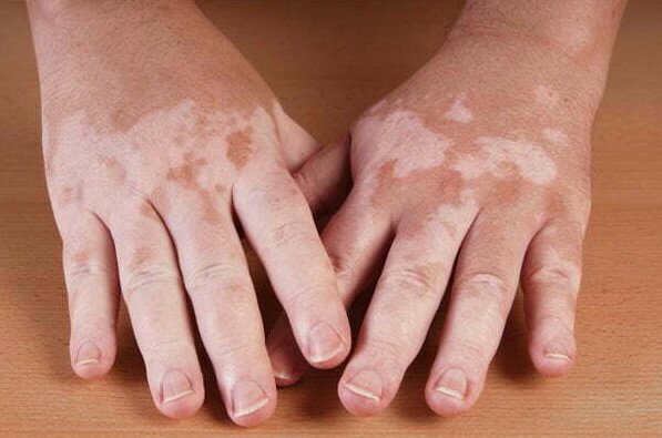 Skin diseases Types and Questions
